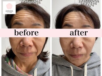 サクラ(SAKURA)/50代おでこのシワ改善◎