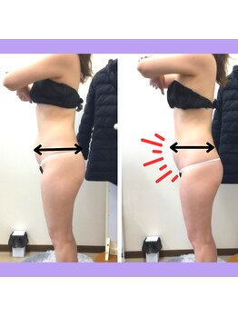 ピアリーノ(Pialino)/たった1回！ビフォーアフター