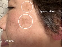 オアシスラグーン(OASIS LAGOON)/シミケア（症例１：before）