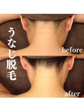 モンレーヴ(MonReve)/うなじ脱毛