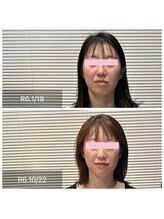 プライミー(PRIMY)/面長改善