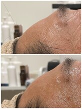 テセラ(Tethere)/額ヒアルリッチ