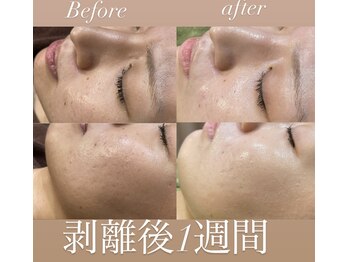 レシェルサロン(Lechelle Salon)/最上級ハーブピーリング