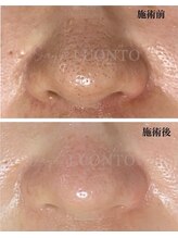 ルオント(LUONTO)/毛穴の開きをどうにかしたい