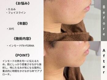 ルディラ医療提携エステ 立川店 毛穴/小顔/ニキビ・シミ・美白・シワ・たるみケア/インモードFX+FORMA
