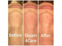 フォーケア(4Care)の雰囲気（ハイドロスキンBeforeAfter1度で効果を実感！肌管理メニュー）