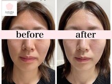 サクラ(SAKURA)/20代30代の効果持続率14日◎