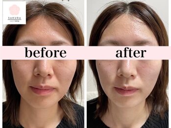 サクラ(SAKURA)/20代30代の効果持続率14日◎