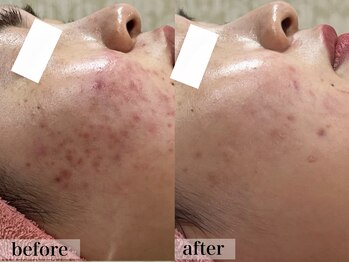 エステサロン ジョアアンジェ(joie ange)/ビオフィート 6回