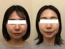プリンセス バイ セイフティプリンセス 長野店(PRINCESS)/《ソフトタッチの》小顔矯正♪