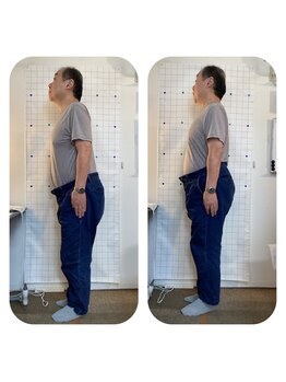 ハンズ治療院 東中野院/「姿勢矯正の症例」