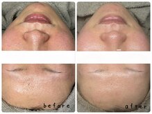 エムベル 越谷レイクタウン店(M belle)/ハーブピーリング