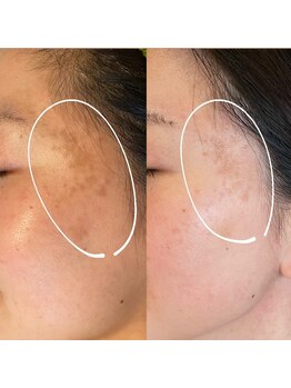 ノイ(Noi)/【シミ】本気の肌質改善