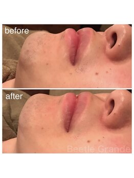 ビューティーモール(BEAUTY MALL)/男性ヒゲ脱毛1回施術