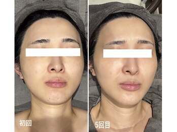 ヴィヴィエ 佐賀店(ViVier)/ララピール症例　５回