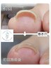 【トラブルフット】巻き爪補正先着10名様限定！施術代半額★◎有資格者施術
