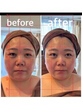 スイレン 西新宿(SUIREN)/エクソソームフェイシャル