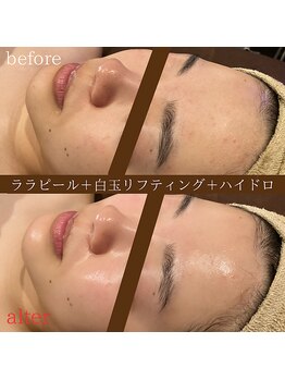 ディースズ(D.suzu)/ララピール×ハイドロ×白玉