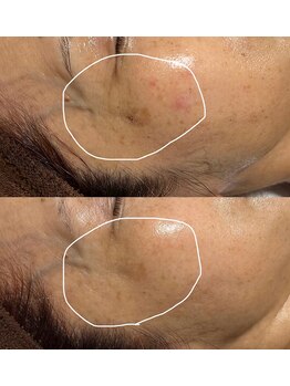 ヨルエステ(yoru aesthe)/【シミケア】