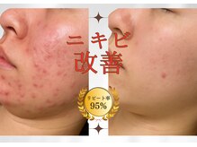 レフアの雰囲気(毛穴/ニキビ改善ハーブピーリング!毛穴の奥からごっそり洗浄★)