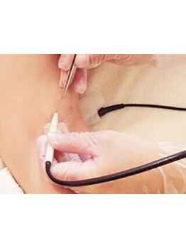 顔脱毛がしたい