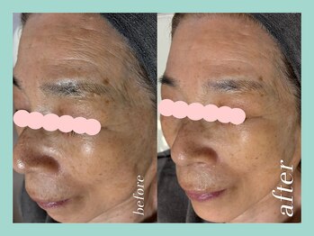 ミウル 天王寺店(miulu)/80代/シミケア照射＋リンパケア