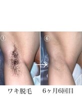 ヴィー(VII)/ワキ脱毛/BeforeAfter