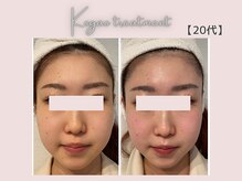 美シェリ(美Cheri)/小顔矯正ビフォーアフター