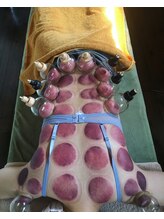 芦田整体療術院/女性にも人気の吸玉療法