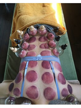 芦田整体療術院/女性にも人気の吸玉療法