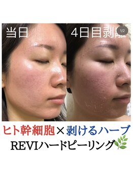 スピカ(Spica)/REVI剥けるハーブピーリング☆