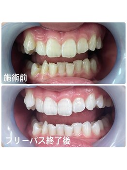 ホワイトニングサロン 京都烏丸店/ホワイトニング施術例