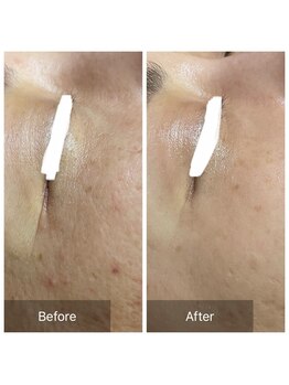 ノルン(Norn)/ハーブピーリング