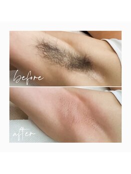 ヒロット タオ(HILOT TAO)/MEN'S脱毛はご紹介に限ります