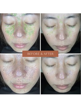 テセラ(Tethere)/1年後のお肌!肌診断機で測定!