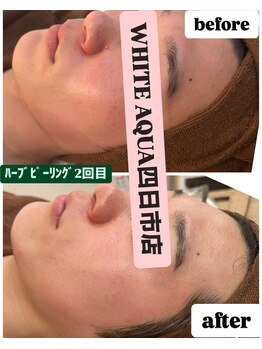 ホワイトアクア 四日市店(WHITE AQUA)/四日市メンズハーブピーリング