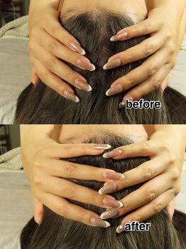 フラーダヴィータ(hlaada.vita)/脳洗浄＋小顔＋小頭の最強コース