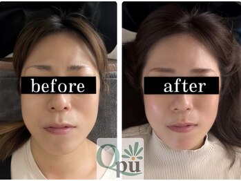 キュープ 富士店(Qpu)/間延び感も改善します/富士/小顔
