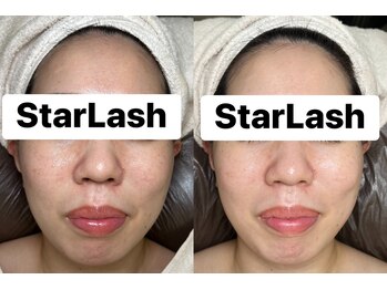 スターラッシュ(Star Lash)/フェイシャル&顔脱毛1回施術前後