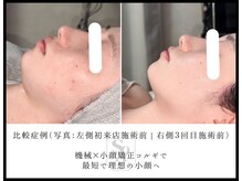 韓国肌管理室 ソア(soa)/【小顔サーマル症例】