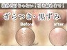 【いちご鼻→つるんと◎】毛穴だけじゃない！小シワ・たるみ◎光フォト付