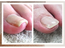 ルポ(REPOS)/巻き爪ケア