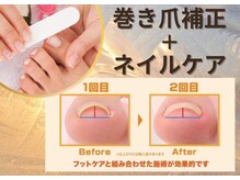 ネイルサロン オー(Oh!)/フット限定　☆巻き爪矯正☆