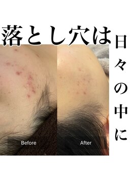 サロンツキ(salon tuki)/ハーブピーリング症例