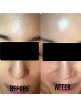 トータルビューティーアンドウィズ(total beauty&WITH)/ツヤ肌！剥離なしピーリング