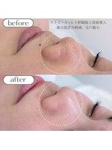 ケアプラス/鼻の毛穴、黒ずみ