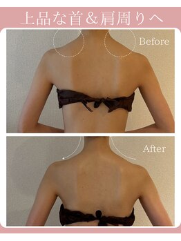 アティレ オオサカ(Attirer Osaka)/ブライダル痩身1回Before→After