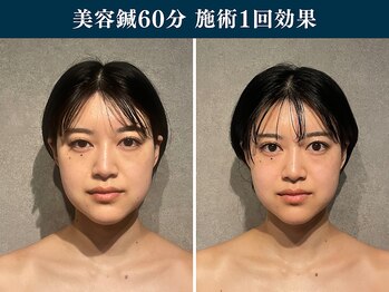 シンク 表参道(CINQ)/美容鍼灸60分1回の変化