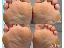 カシェット 広島店(Cachette)/40代女性☆足裏角質ケア90分