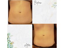 トータルボディサロン グリーン 日本橋駅前店(Green)/ハイパーナイフ×キャビ[4ヶ月]